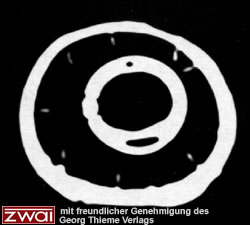 Abb. 2 Cuffkan�lchen (ovale wei�e Stellen). CT-Aufnahme eines geblockten
HVLP-Cuffs in einer Tierluftr�hre. Quelle: microcuff GmbH, Weinheim.